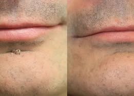✨LUMIVO™2-in-1 Microneedle & Hydrocolloid Patch🍀| Removes Raised Moles, Acne, Flat Warts & Skin Tags | Helps Improve Wrinkles, Scars & Blemishes | Invisible Patches for Face & Body