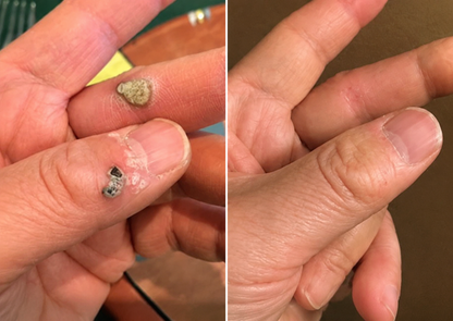 ✨LUMIVO™2-in-1 Microneedle & Hydrocolloid Patch🍀| Removes Raised Moles, Acne, Flat Warts & Skin Tags | Helps Improve Wrinkles, Scars & Blemishes | Invisible Patches for Face & Body