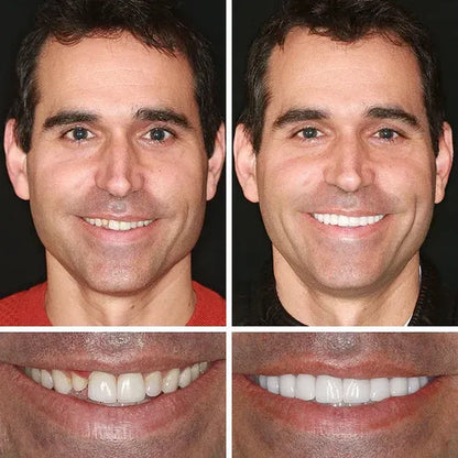 🎁🌎Ends Today: 70% OFF! ⏰meleval® Medical Full Denture with Strong Suctiond🦷Obtain American Dental Association (ADA) Certification