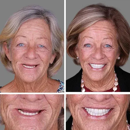 🎁🌎Ends Today: 70% OFF! ⏰meleval® Medical Full Denture with Strong Suctiond🦷Obtain American Dental Association (ADA) Certification
