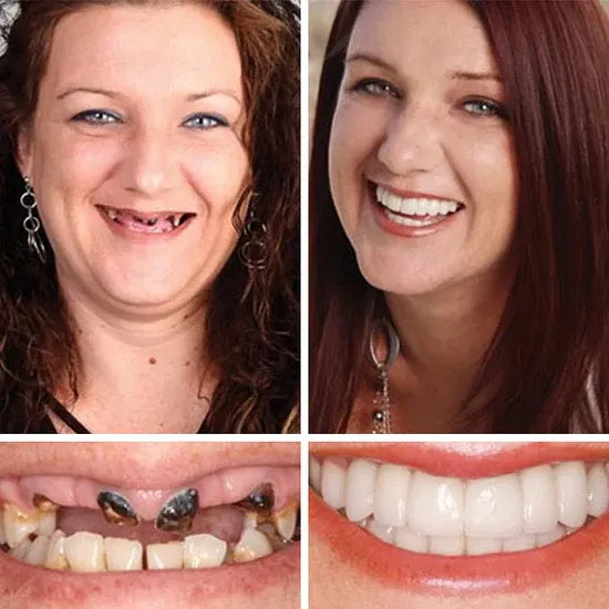 🎁🌎Ends Today: 70% OFF! ⏰meleval® Medical Full Denture with Strong Suctiond🦷Obtain American Dental Association (ADA) Certification