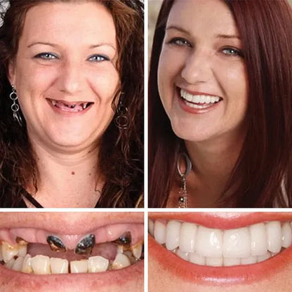 🎁🌎Ends Today: 70% OFF! ⏰meleval® Medical Full Denture with Strong Suctiond🦷Obtain American Dental Association (ADA) Certification