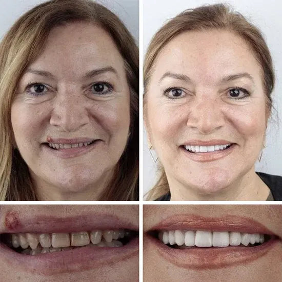 🎁🌎Ends Today: 70% OFF! ⏰meleval® Medical Full Denture with Strong Suctiond🦷Obtain American Dental Association (ADA) Certification